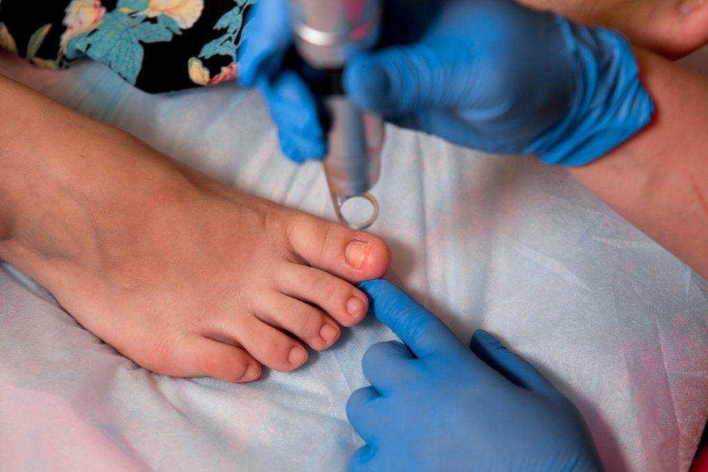 Serviço Laser Podológico - Rovania Zambon